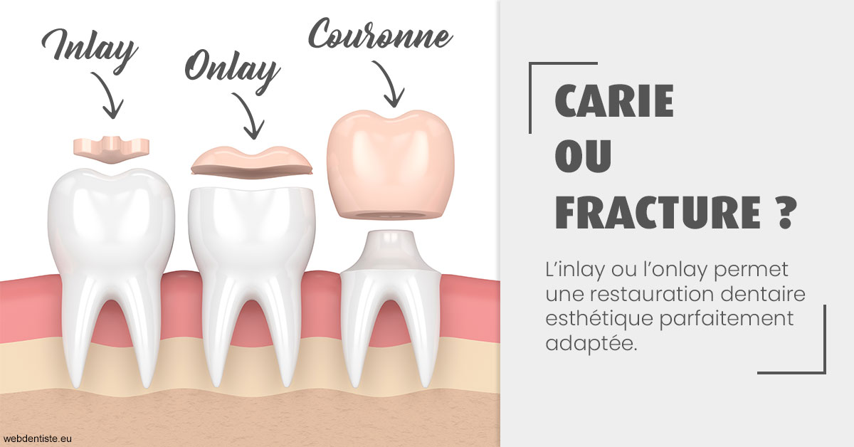 https://www.drrichardgrosman.fr/T2 2023 - Carie ou fracture 1