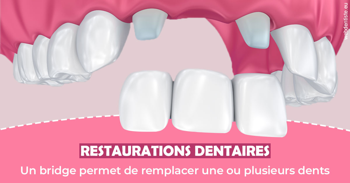 https://www.drrichardgrosman.fr/Bridge remplacer dents 2