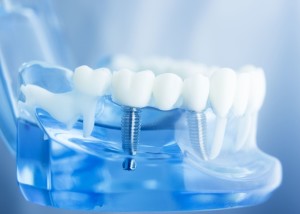 Implants dentaires Paris 2 - Cabinet dentaire du Docteur Richard Grosman
