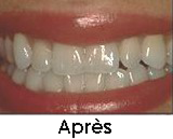 Blanchiment dentaire Paris 2 - Les différentes techniques de blanchiment