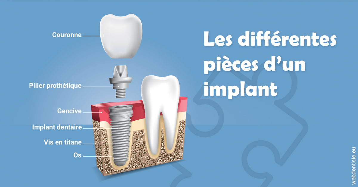 https://www.drrichardgrosman.fr/Les différentes pièces d’un implant 1