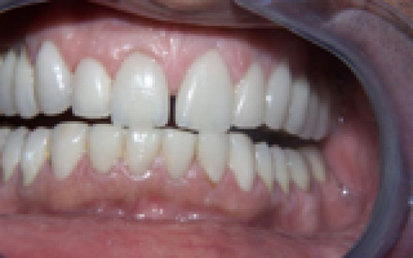 Facettes dentaires paris 2- Les facettes céramiques